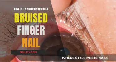 Icing a Bruised Fingernail: How Often is Too Often?