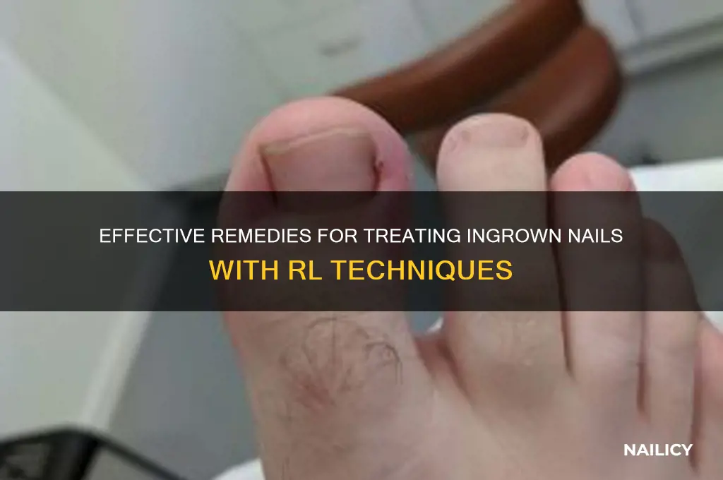 how rl treat ingeown nail