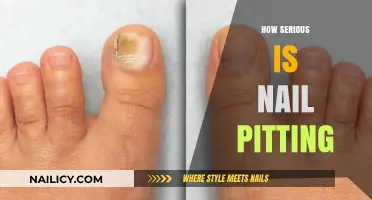 Nail Pitting: Uncovering the Severity and Health Implications