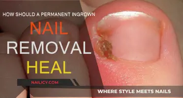 Ingrown Nail Removal: What to Expect During Healing