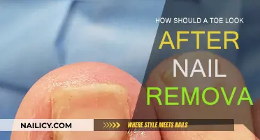 Toe Transformation: Post-Nail Removal Appearance