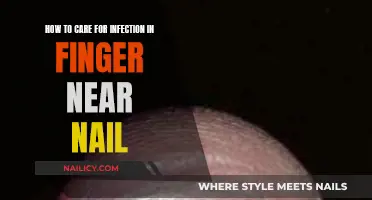 Treating Finger Infections Near Nails: Quick Guide