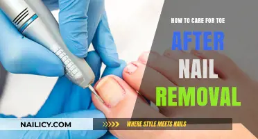 Toe Care: Post-Nail Removal Guide