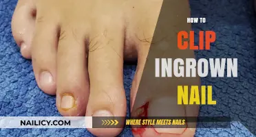 Effective Steps to Safely Clip and Treat Ingrown Nails at Home