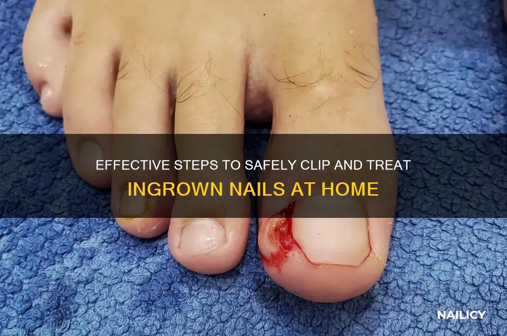 how to clip ingrown nail