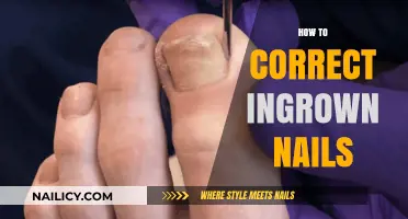 Effective Tips to Correct and Prevent Painful Ingrown Toenails at Home