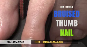 Effective Remedies to Heal and Soothe a Bruised Thumb Nail Fast