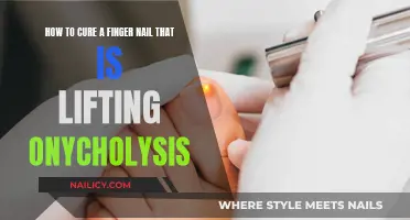 Healing Lifting Nails: Onycholysis Treatment Guide