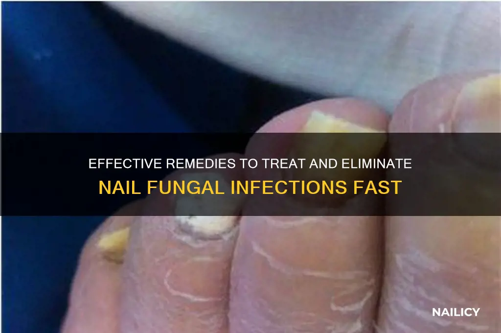 how to cure a nail fungal infection
