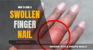 Relieve a Swollen Fingernail: Home Remedies and Tips