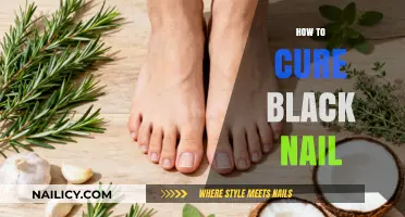 Effective Remedies to Treat and Cure Black Nails at Home