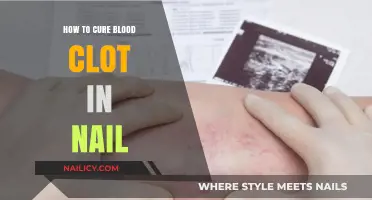 Effective Remedies to Treat and Prevent Blood Clots Under Nails