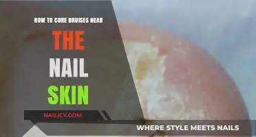 Effective Remedies for Healing Bruises Near Nail Skin Quickly