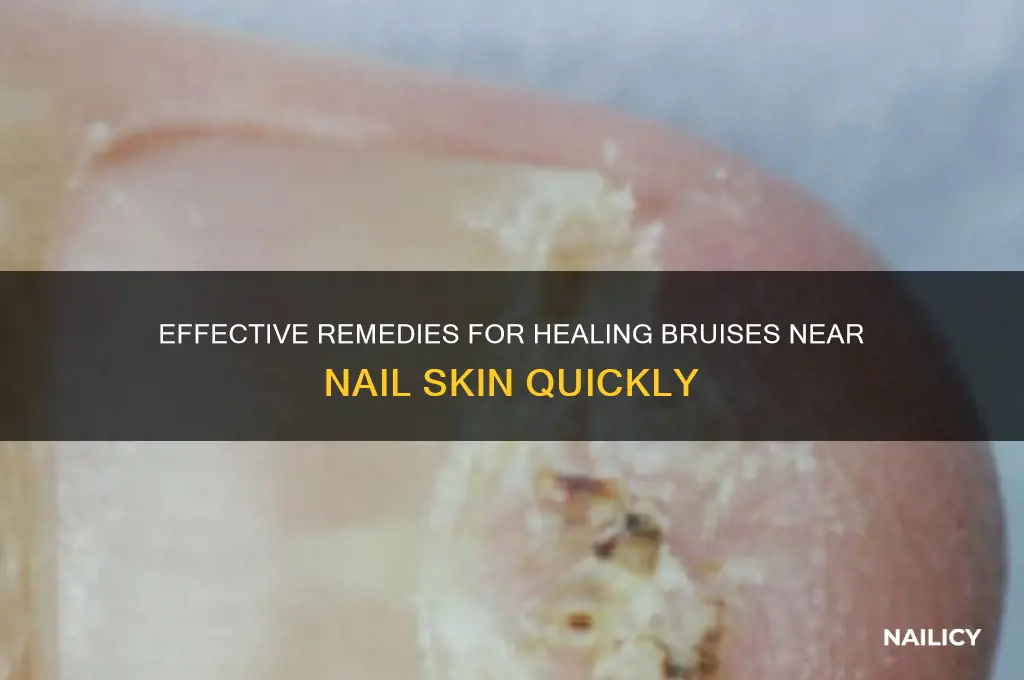 how to cure bruises near the nail skin
