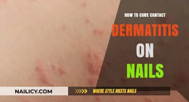 Effective Remedies to Heal Contact Dermatitis on Your Nails Fast