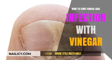 Effective Vinegar Remedies to Treat and Cure Fungal Nail Infections