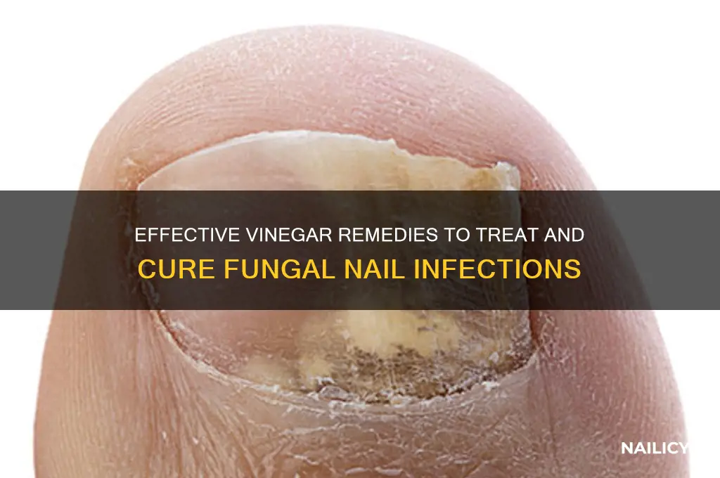 how to cure fungal nail infection with vinegar