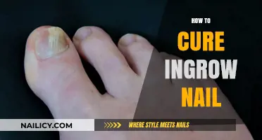 Effective Remedies and Prevention Tips for Treating Ingrown Toenails