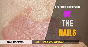 Effective Treatments for Healing Lichen Planus of the Nails