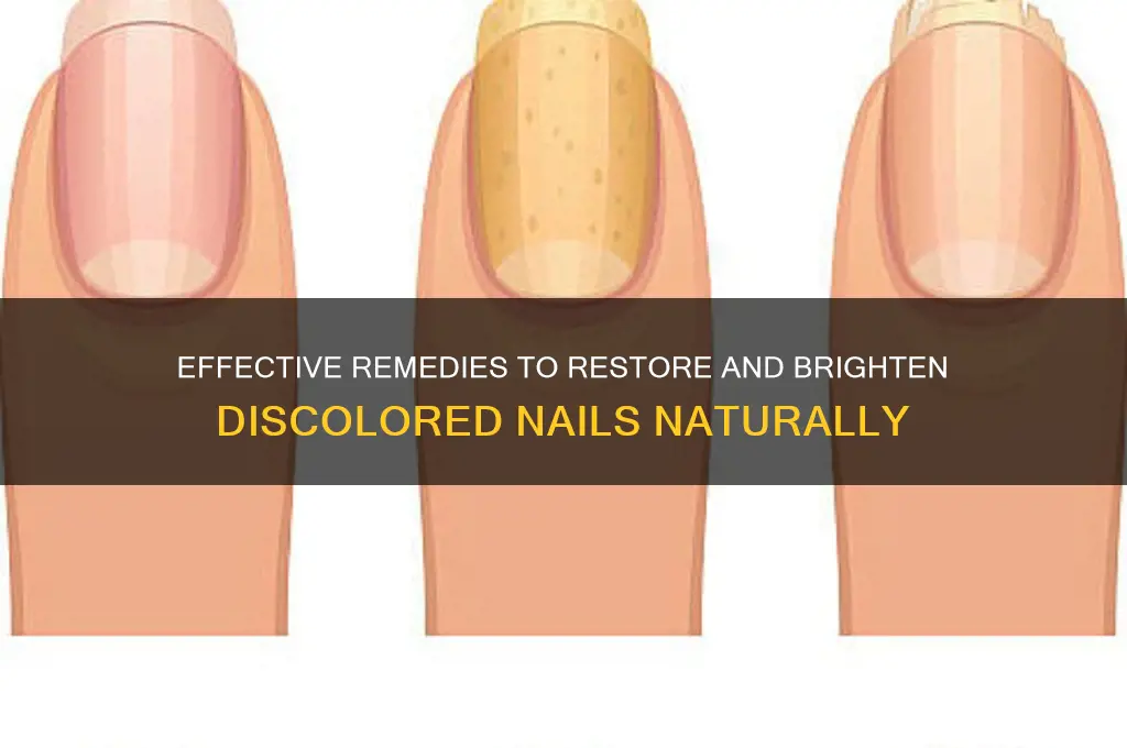 how to cure nail discoloration