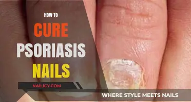 Effective Remedies to Heal and Restore Psoriasis-Affected Nails Naturally