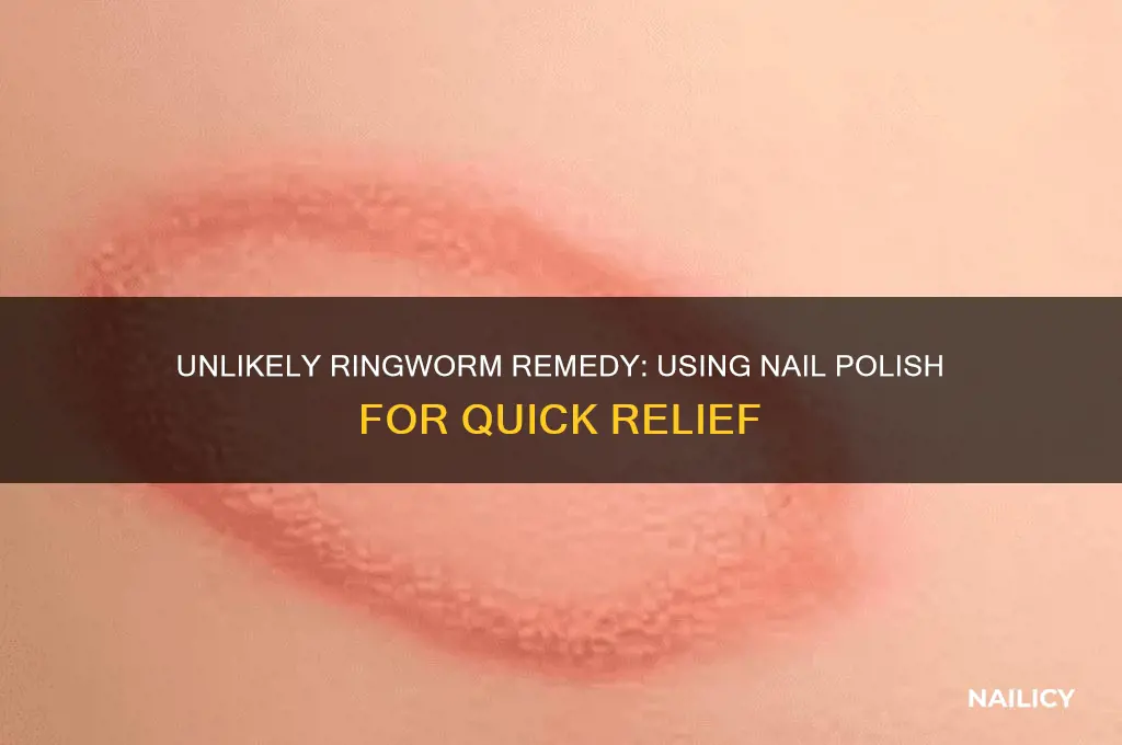 how to cure ringworm with nail polish