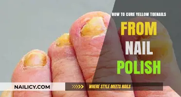 Cure Yellow Toenails: Effective Remedies for Nail Polish Stains