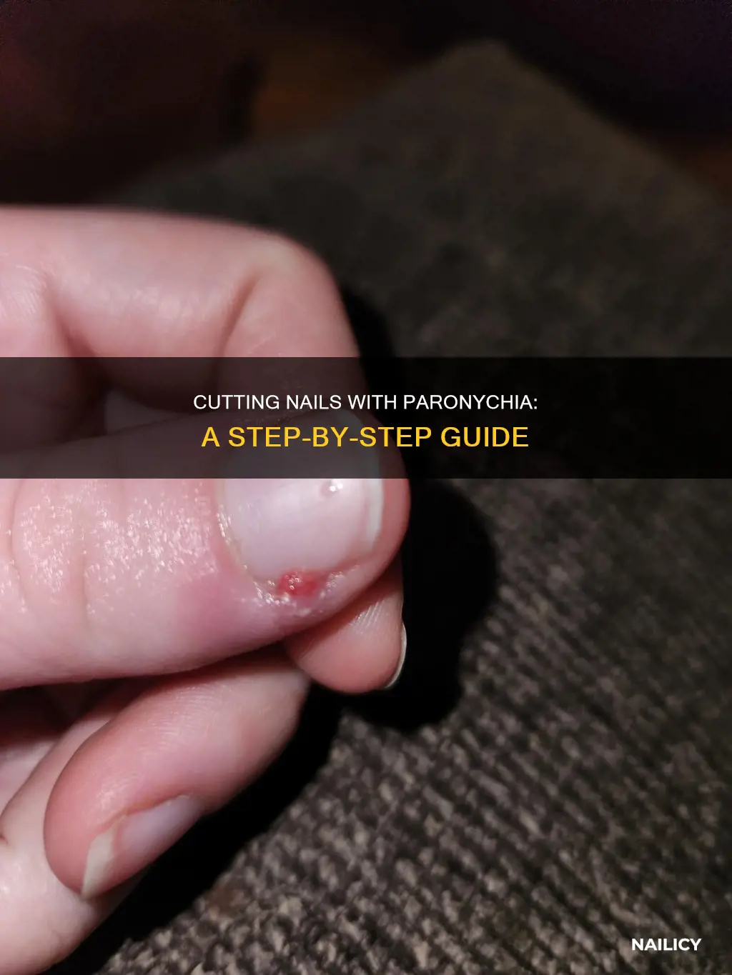 how to cut nails for paronychia