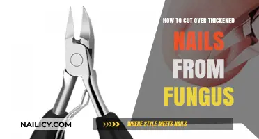 Get Rid of Thickened Nails: Toenail Fungus Treatment