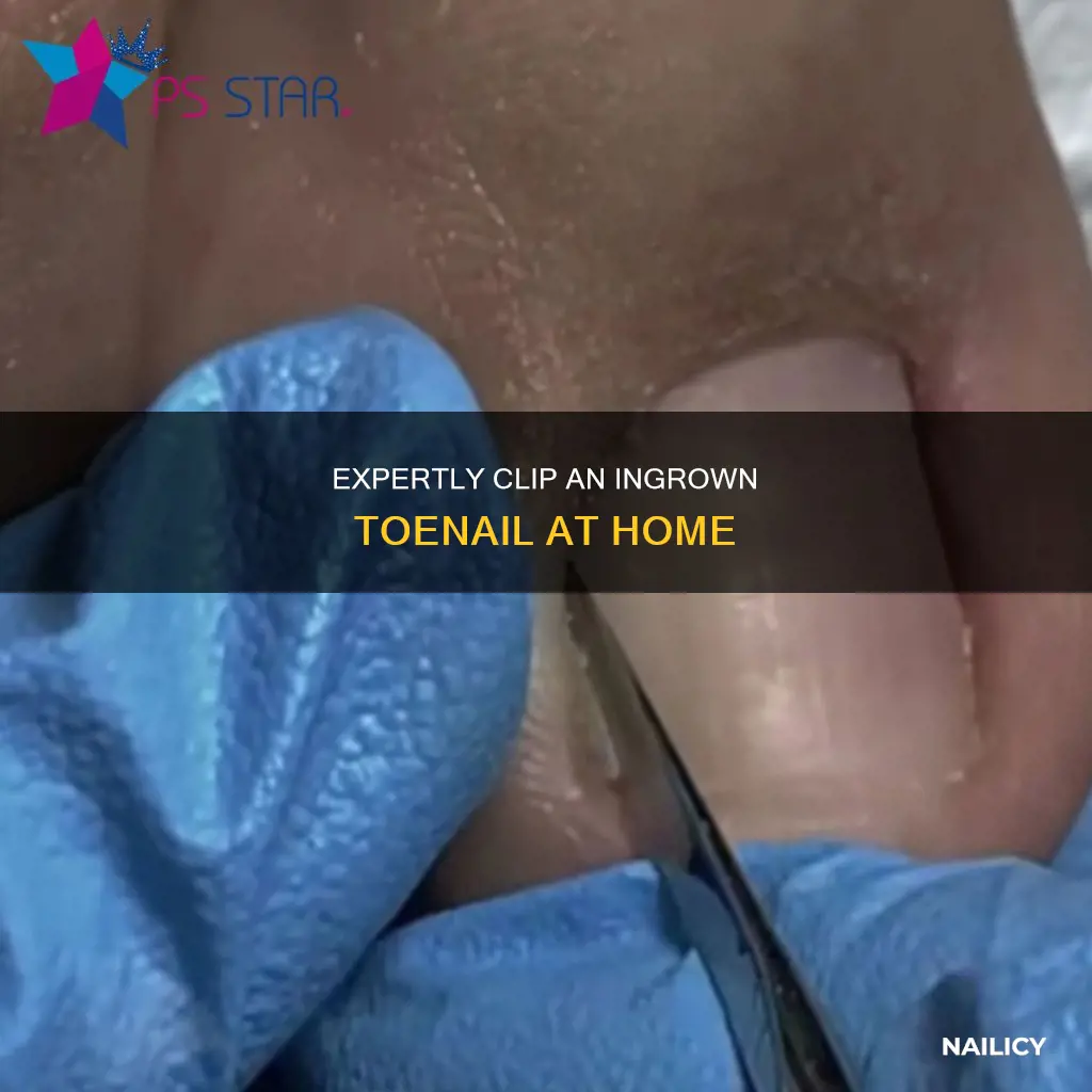 how to cut through a ingrown nail