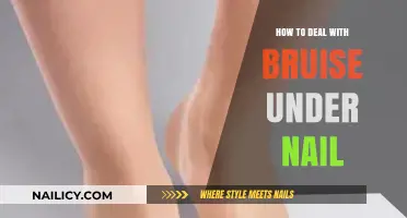 Healing a Painful Subungual Hematoma: Effective Tips and Remedies