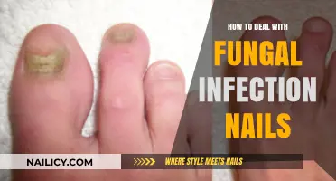 Effective Strategies to Treat and Prevent Fungal Nail Infections