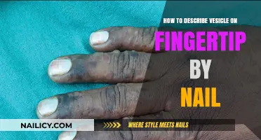 Identifying and Describing Fingertip Vesicles Using Your Nail: A Guide