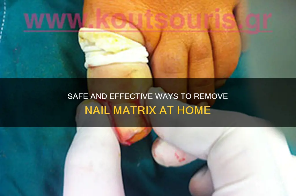 how to destroy nail matrix at home