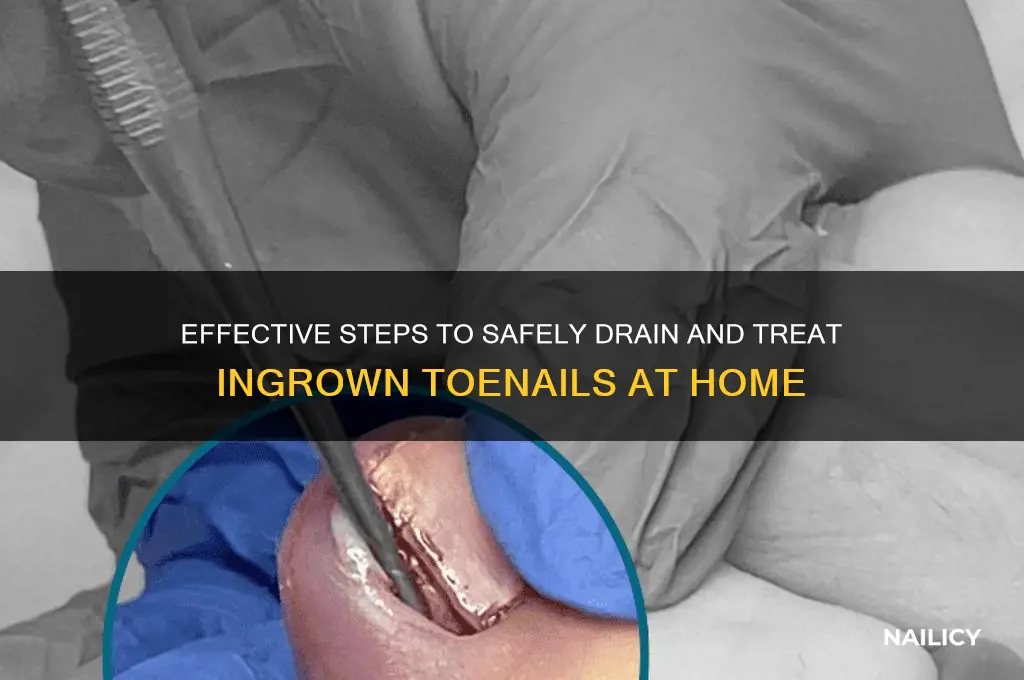 how to drain ingrown nail