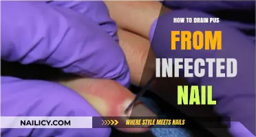 Effective Steps to Safely Drain Pus from an Infected Nail