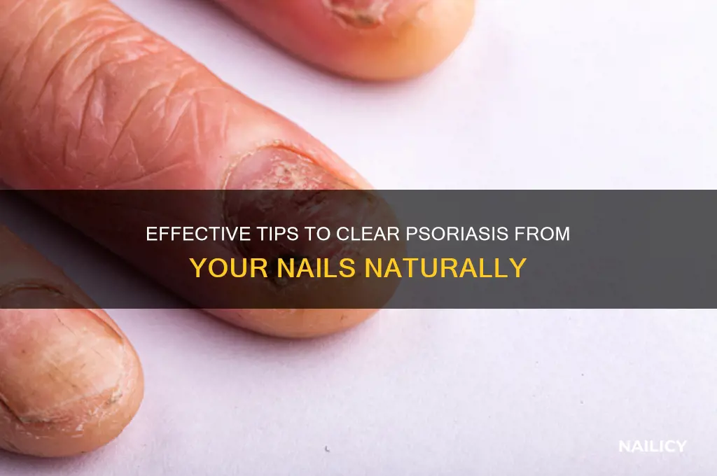 how to fet psoriasis out of nails