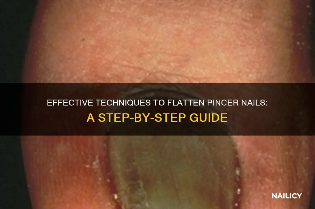 how to flatten pincer nail