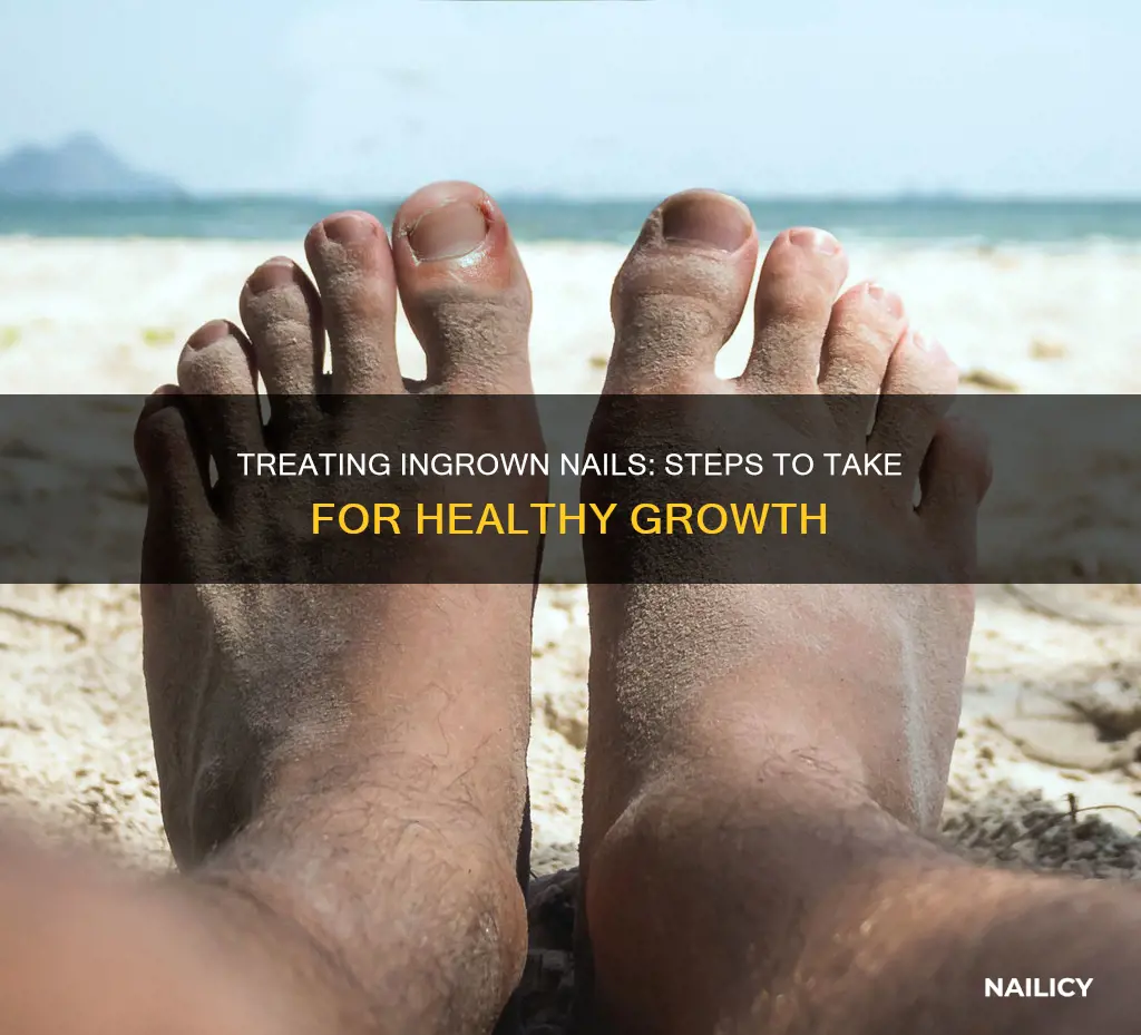 how to grow out an ingrown nail