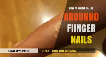Effective Tips to Treat and Prevent Calluses Around Finger Nails