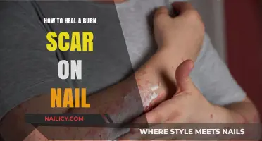 Effective Ways to Heal and Fade Burn Scars on Nails