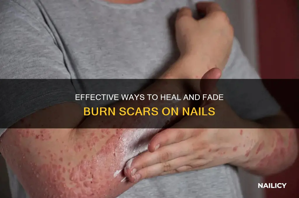 how to heal a burn scar on nail