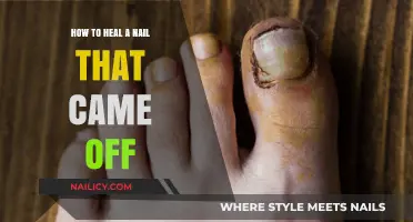 Healing a Detached Nail: Effective Steps for Recovery and Care