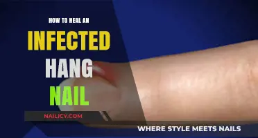 Healing Infected Hangnails: Quick Remedies and Prevention Tips