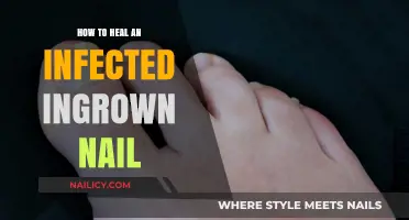 Effective Remedies to Heal and Prevent Infected Ingrown Toenails Fast