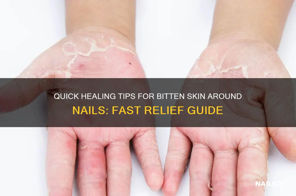 how to heal bitten skin around nails fast