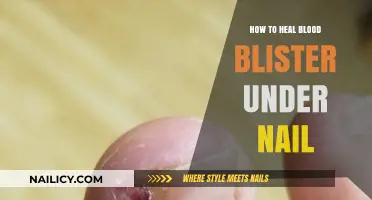 Healing Blood Blisters Under Nails: Effective Remedies and Prevention Tips