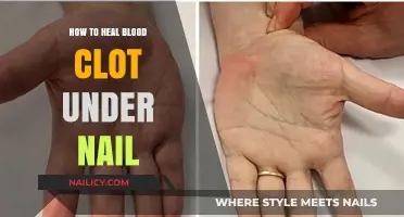 Healing a Blood Clot Under Your Nail: Effective Remedies and Tips