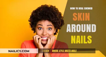 Heal Chewed Skin Around Nails: Effective Remedies and Prevention Tips