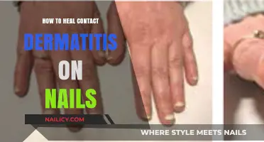 Healing Contact Dermatitis on Nails: Effective Remedies and Prevention Tips